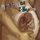 C-Section