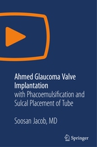 SN Video Medicine and Life Sciences, Ahmed Glaucoma Valve Implantation