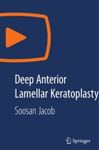 SN Video Medicine and Life Sciences, Deep Anterior Lamellar Keratoplasty