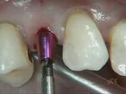 Soft and Hard Tissue Management With One Piece Implants