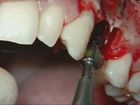 Extraction of fractured maxillary premolar treated with implant placement and simultaneous bone graft