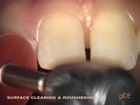 Treatment of 6 anterior damaged teeth with Composite direct Veneers