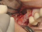 Sinus Lift using lateral window approach with placement of 2 implants