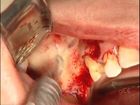 Sinus lift bone graft in minimal crestal bone height and septum with delayed implant placement