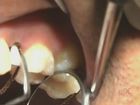 Final implant restorative treatment using Procera crown after implant healing and Patient interview