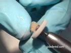 Corkscrew Implant: Extraction - Immediate Temporization