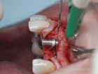 Treatment of Multiple Gingival Recessions using a Tunneling approach, Alloderm and Emdogain
