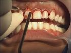 Periodontal Surgery for Esthetic Crown Lengthening