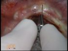 Soft Tissue Management During Maxillary Implant Recovering