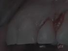 Treatment of Single Gingival Recession with Application of Alloderm and Emdogain