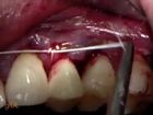Single Implant Placement for Missing Upper Premolar: Restorative Options
