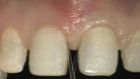 Previsualization - A Useful System for Truly Informed Esthetic Treatment