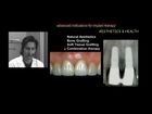 Advanced Implant Therapy, 1, Biological elements in achieving natural implant aesthetics