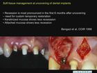 Advanced Implant Therapy, 11, Soft Tissue Management and Grafting around Dental Implants - Esthetic and Mucogingival solutions