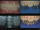 Guided Implant Surgery - A New Dimension in Surgical Precision