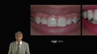 Achieving Esthetic Predictability in Periodontology Part 1: Crown Lengthening