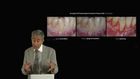 Achieving Esthetic Predictability in Periodontology Part 2: Treatment of Gingival Recession