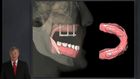 Treating the Edentulous Arch with Removable Implant Overdentures Impression Technique