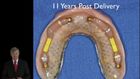 Procera CAD-CAM Technology with Bar Overdentures and Fixed Implant Restorations