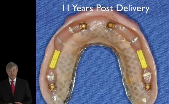 Procera CAD-CAM Technology with Bar Overdentures and Fixed Implant ...
