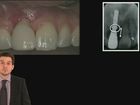 Predictability of the Extraction Site Implant Part 1: Do We Need a Buccal Plate?