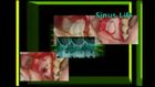 Predictable and Successful Maxillary Sinus Augmentation