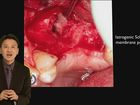 Classification for Minimally Invasive Sinus Bone Grafting, Part 1 of 2
