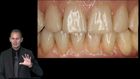 High End Implant Solutions for Patients with an Angle Class II Downhill Dentition