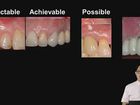 Soft Tissue Grafting for Implant Complications in the Esthetic Zone