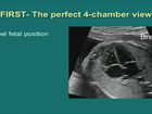 Screening the Fetal Heart Outflow Tracts Part 2