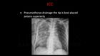 Chest X-Ray Interpretation, Part 3, Tubes and Lines