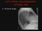 Chest X-Ray Interpretation, Part 4, Cardiomediastinal Contours