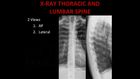 Emergency X-Ray Interpretation, Part 3, Thoracolumbar Spine