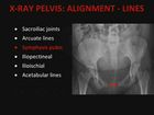 Emergency X-Ray Interpretation, Part 4, Pelvis