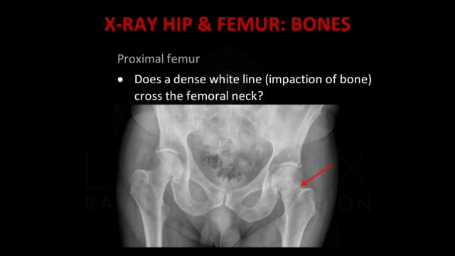 femur x ray anatomy