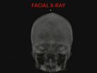 Emergency X-Ray Interpretation, Part 7, Skull and Face