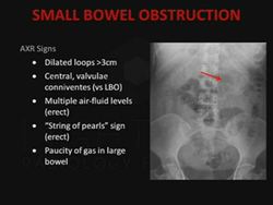 psoas sign x ray