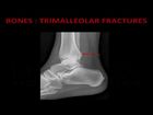 Nursing X-Ray Interpretation, Part 4, Ankle and Foot
