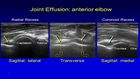 Ultrasound Evaluation of the Elbow Pathology