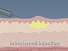 Administering Medications: Injections, Types Of Injections