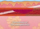 Intravenous Therapy, Recognizing and Treating Complications: Thrombosis or Thrombophlebitis