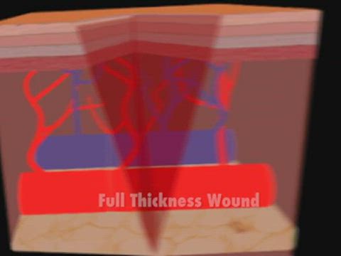 full thickness wound