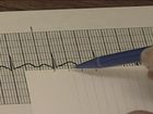 EKG Interpretation and Response: Reading an EKG, How To Calculate Heart Rate On the EKG