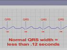 EKG Interpretation and Response: Reading an EKG, Assessing Normal Sinus Rhythm with the Seven Step Method