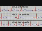 EKG Interpretation and Response: Sinus Dysrhythmias, Sinus dysrhythmias   (Superseded)