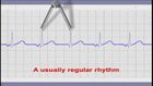 EKG Interpretation and Response: Atrial and Junctional Dysrhythmias and Heart Block, Junctional dysrhythmias