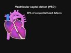Assessment of the Newborn, Cardiopulmonary Assessment and Cardiac Anomalies: Ventricular septal defect (VSD)