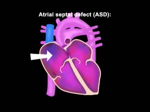 Assessment of the Newborn, Cardiopulmonary Assessment and Cardiac  Anomalies: Atrial septal defect (ASD) | Alexander Street, part of Clarivate