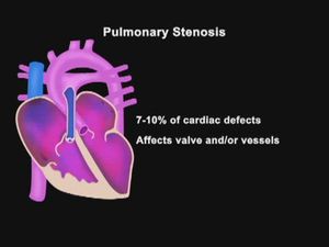 Assessment of the Newborn: Cardiopulmonary Assessment and Cardiac Anomalies, Pulmonary stenosis