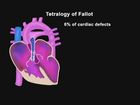 Assessment of the Newborn: Cardiopulmonary Assessment and Cardiac Anomalies, Tetralogy of Fallot
